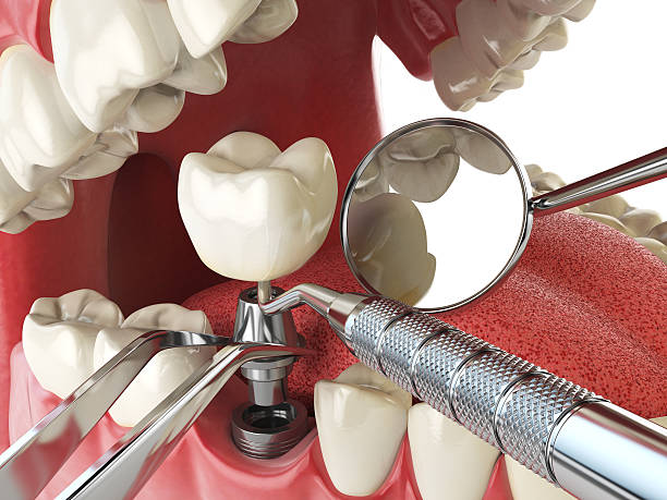 Best Emergency Tooth Extraction  in Vine Hill, CA
